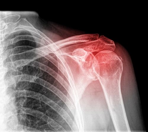 Understanding Work-related Shoulder Injuries